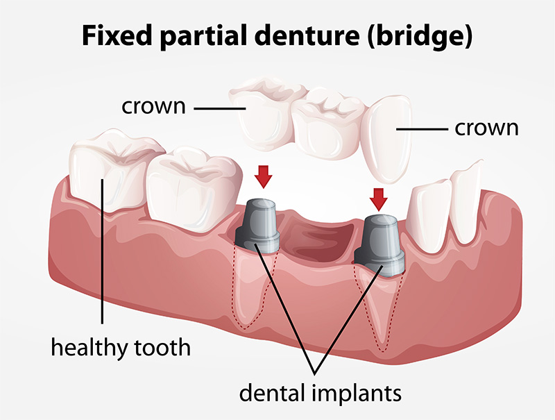 Dental Bridge | Fixed Partial Denture | Imagine Family Dentistry | St. George UT